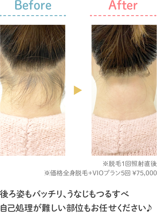 後ろ姿もバッチリ、うなじもつるすべ。自己処理が難しい部位もお任せください。