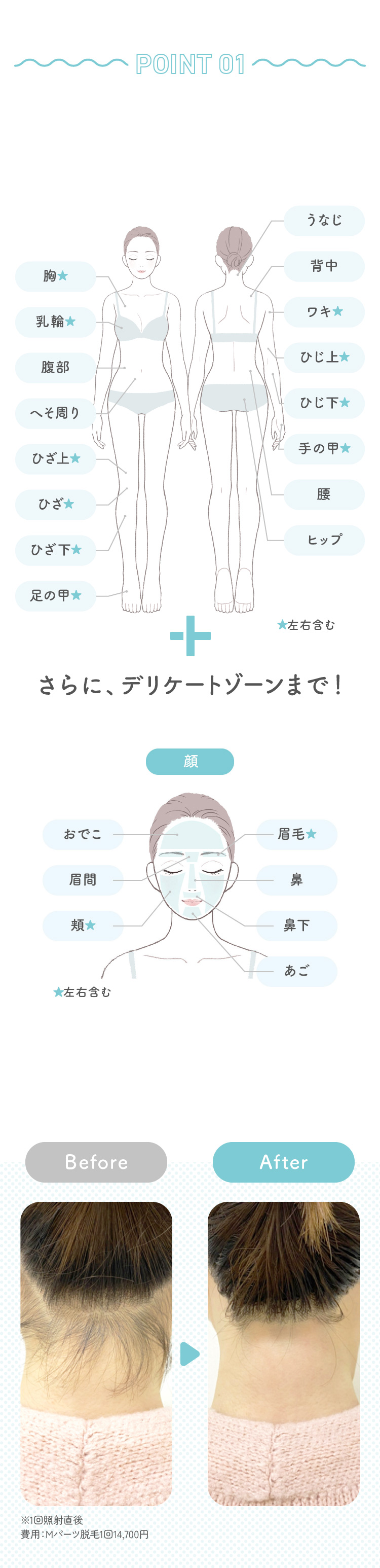 point1 26箇所セットでまるっと全身脱毛