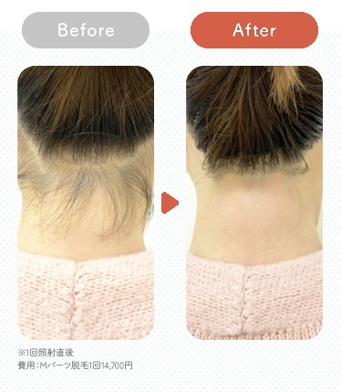 うなじ脱毛のBefore After ※1回照射直後 費用：Mパーツ脱毛1回14,700円