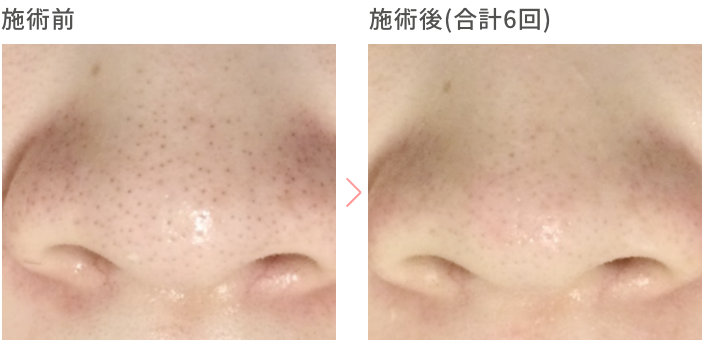 施術前 施術後