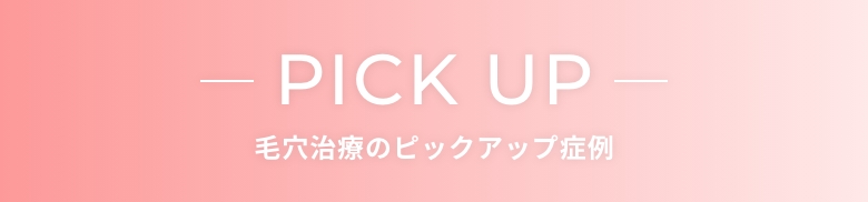 PICK UP ニキビ治療のピックアップ症例