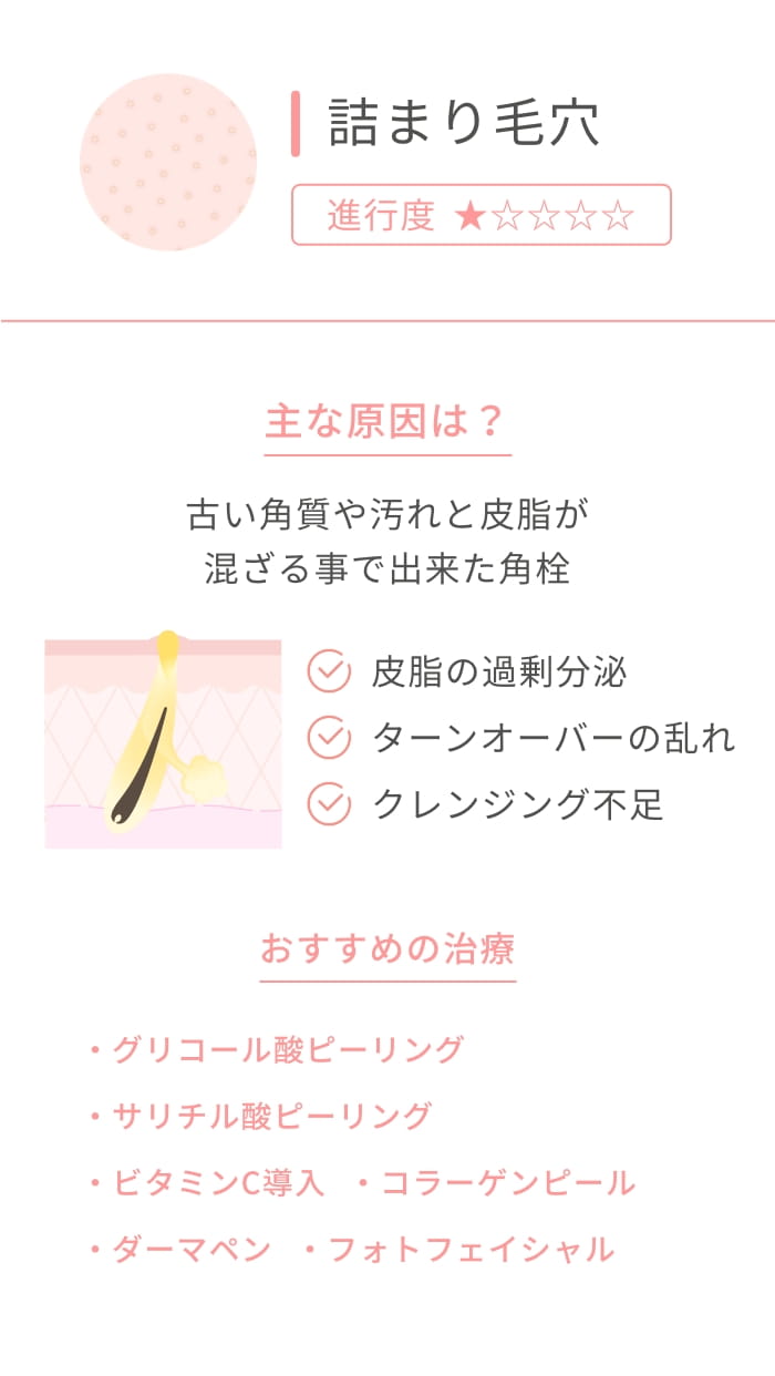 詰まり毛穴 進行度★ 主な原因は？ 古い角質や汚れと皮脂が混ざる事で出来た角栓 皮脂の過剰分泌 ターンオーバーの乱れ クレンジング不足 おすすめの治療 ケミカルピーリング ビタミンC導入 コラーゲンピール ダーマペン フォトフェイシャル