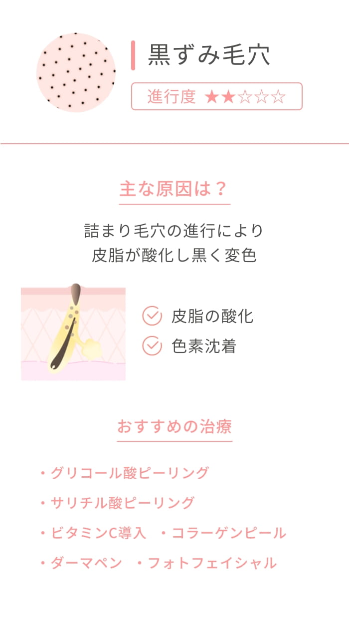 黒ずみ毛穴 進行度★★主な原因は？ 詰まり毛穴の進行により皮脂が酸化し黒く変色 皮脂の酸化 色素沈着 おすすめの治療 ケミカルピーリング ビタミンC導入 コラーゲンピール ダーマペン フォトフェイシャル
