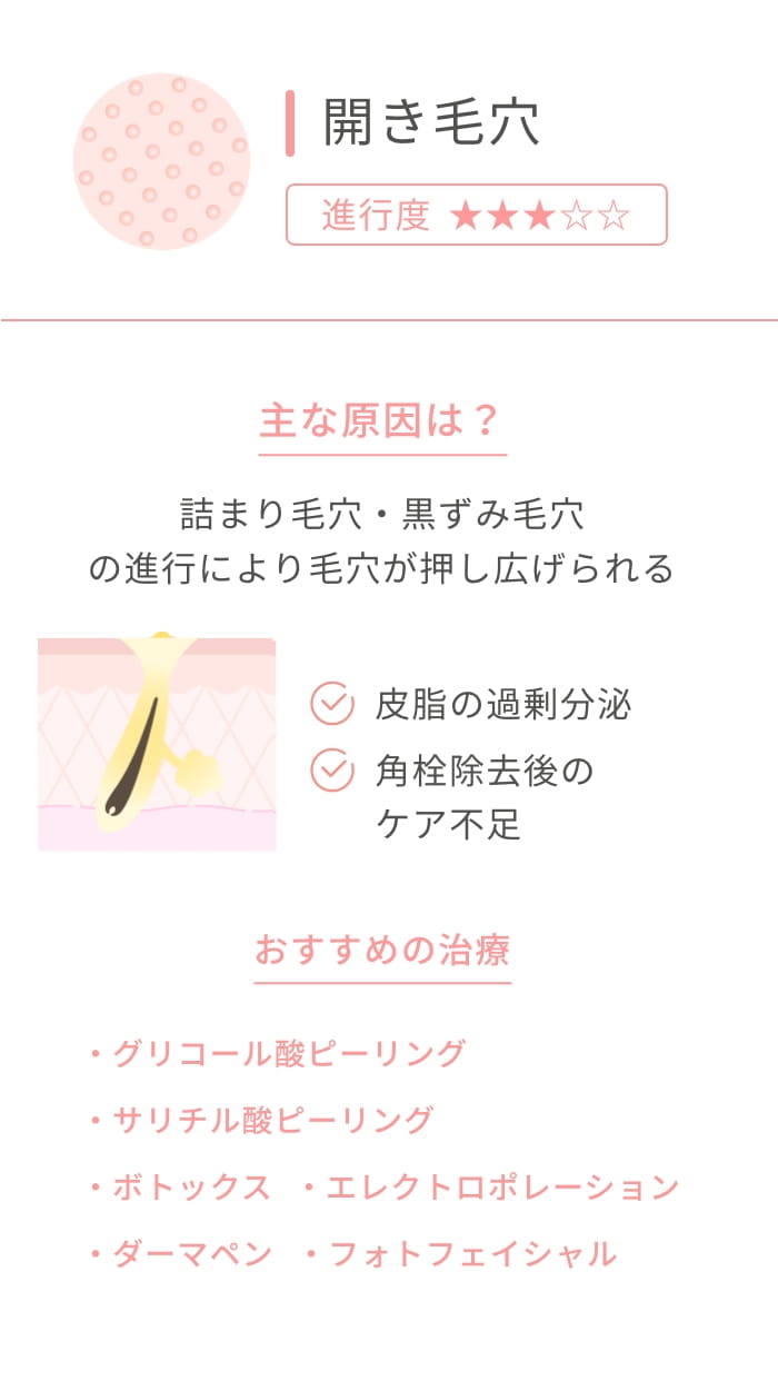 開き毛穴 進行度★★★ 主な原因は？ 詰まり毛穴・黒ずみ毛穴の進行により毛穴が押し広げられる 皮脂の過剰分泌 角栓除去後のケア不足 おすすめの治療 ケミカルピーリング ボトックス エレクトロポレーション ダーマペン フォトフェイシャル