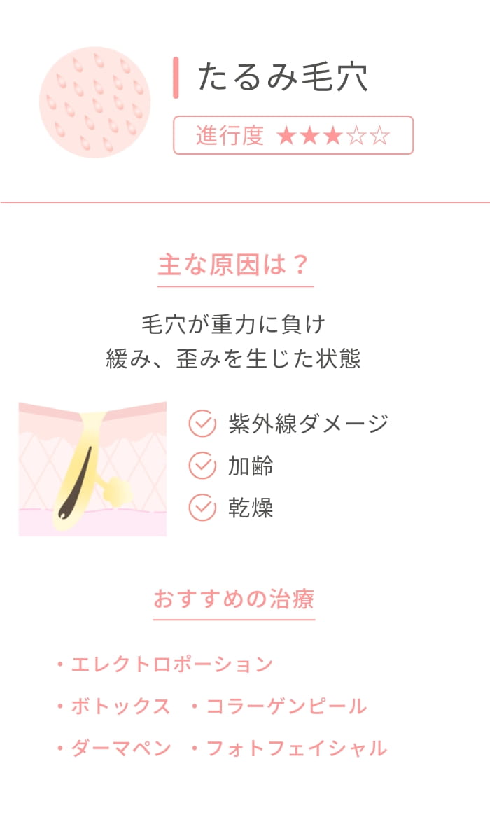たるみ毛穴 進行度★★★ 主な原因は？ 毛穴が重力に負け緩み、歪みを生じた状態 紫外線ダメージ 加齢 乾燥 おすすめの治療 エレクトロポーション ボトックス コラーゲンピール ダーマペン フォトフェイシャル