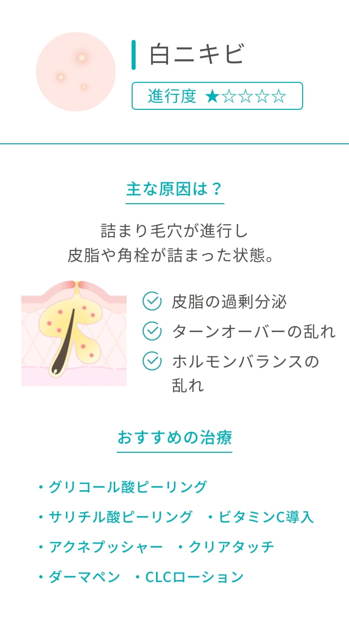 白ニキビ 進行度★ 主な原因は？ 古詰まり毛穴が進行し 皮脂や角栓が詰まった状態。 皮脂の過剰分泌 ターンオーバーの乱れ ホルモンバランスの乱れ クレンジング不足 おすすめの治療 ケミカルピーリング ビタミンC導入 アクネプッシャー クリアタッチ ダーマペン CLCローション