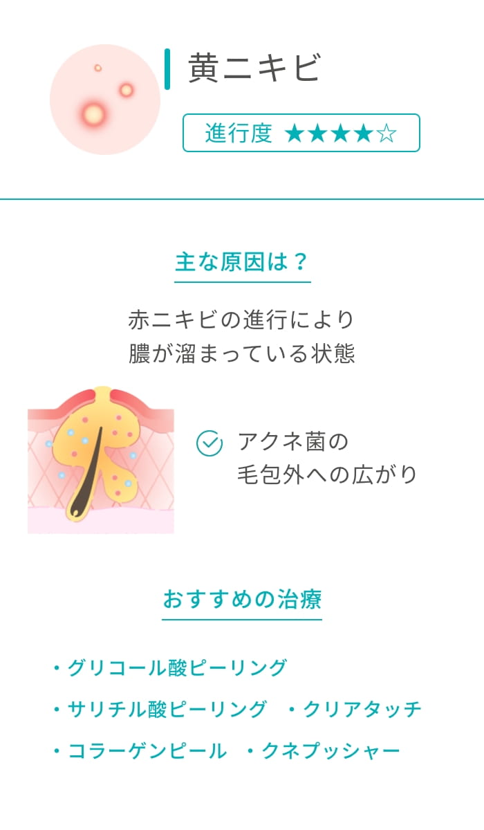 黄ニキビ 進行度★★★★ 主な原因は？ 赤ニキビの進行により膿が溜まっている状態 アクネ菌の毛包外への広がり おすすめの治療 ケミカルピーリング コラーゲンピール アクネプッシャー クリアタッチ