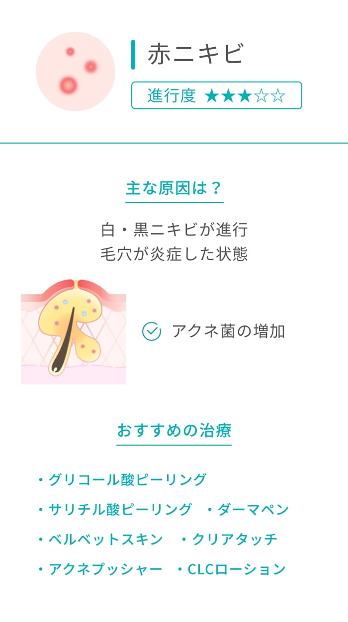赤ニキビ 進行度★★★ 主な原因は？ 白・黒ニキビが進行、毛穴が炎症した状態 アクネ菌の増加 おすすめの治療 ケミカルピーリング ベルベットスキン アクネプッシャー クリアタッチ ダーマペン CLCローション