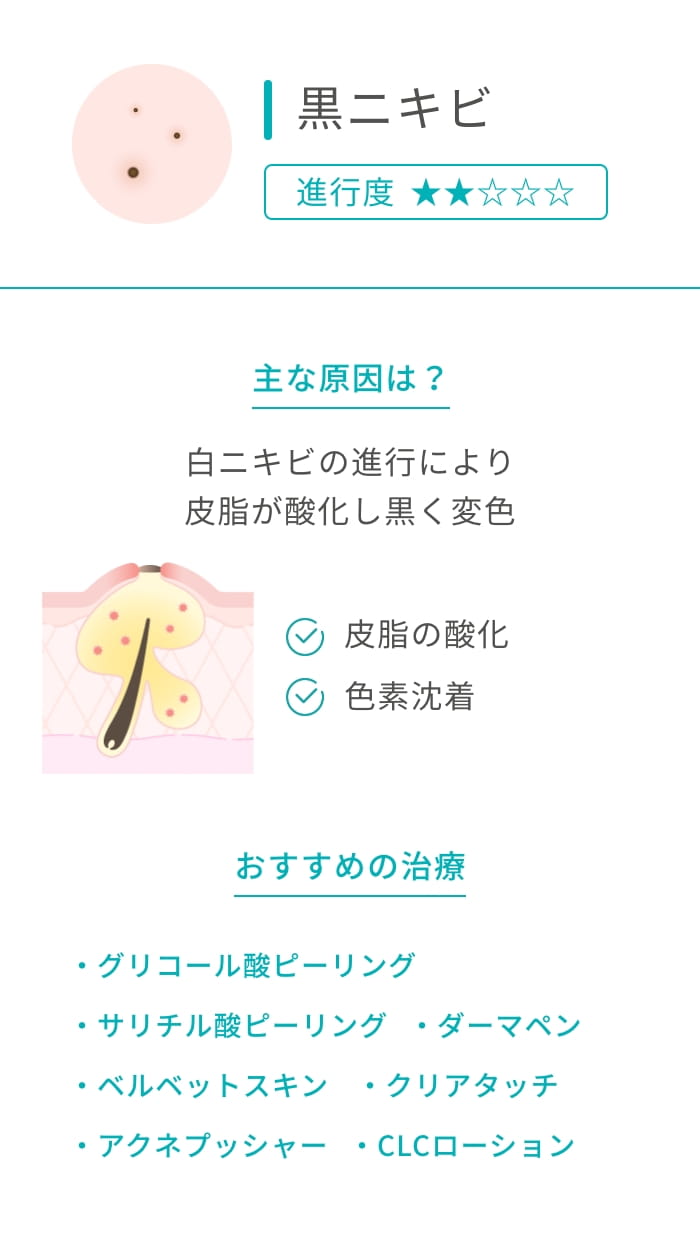 黒ニキビ 進行度★★ 主な原因は？ 白ニキビの進行により皮脂が酸化し黒く変色 皮脂の酸化 色素沈着 おすすめの治療 ケミカルピーリング ベルベットスキン アクネプッシャー クリアタッチ ダーマペン CLCローション